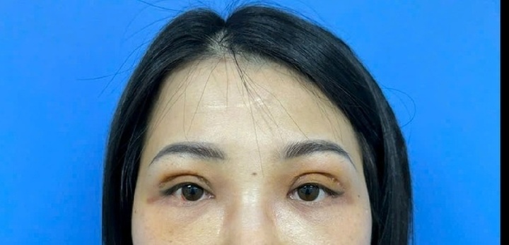 Bi hài hậu vận sau thẩm mỹ: Cô gái 