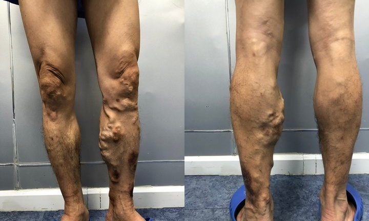 Chuyên gia cảnh báo căn bệnh nguy hiểm đang trẻ hóa: 