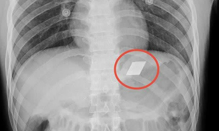 Cứu sống người đàn ông nuốt 4 lưỡi dao rọc giấy vào bụng