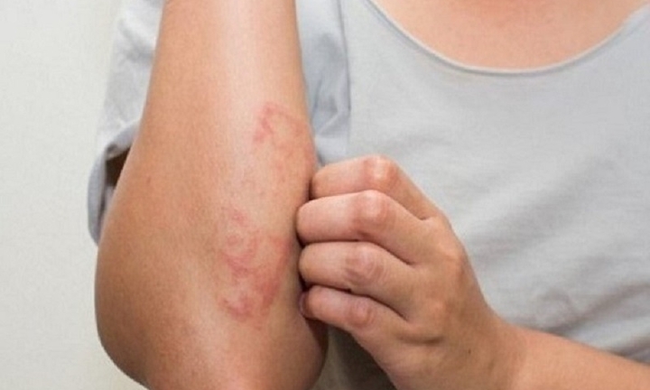 Cô gái nhiễm cùng lúc 2 loại giun sán từ thói quen nuôi thú cưng, ăn rau sống