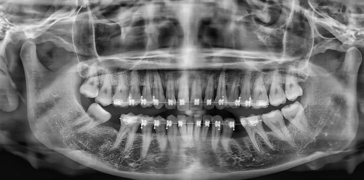 Mất trắng 25 triệu, cô gái rơi vào trầm cảm sau 3 năm niềng răng hỏng