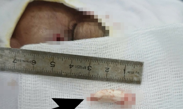 Người đàn ông gặp họa trong lúc cho gà ăn, suýt mất thị lực