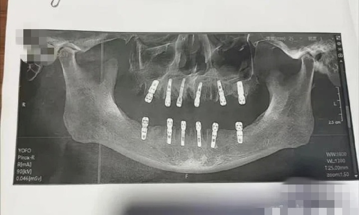 Cụ ông 77 tuổi tử vong sau cấy 6 implant và nhổ 12 răng