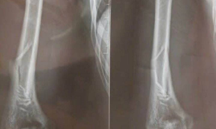 Hà Nội: Nam thanh niên 18 tuổi gãy xương cánh tay sau khi chơi vật tay với bạn