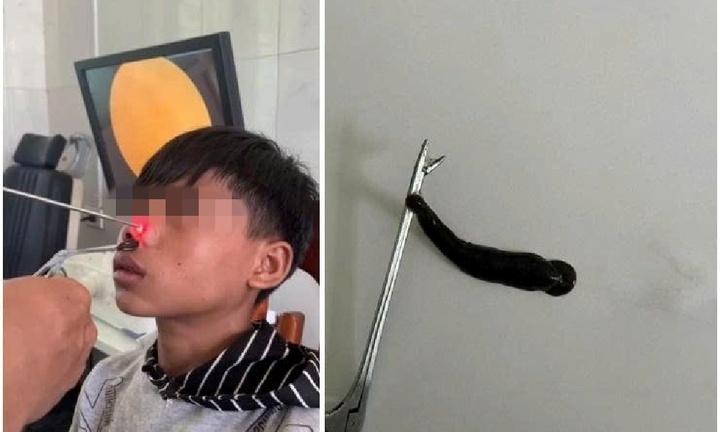Gắp con đỉa dài 4cm ký sinh trong mũi bé trai suốt 10 ngày