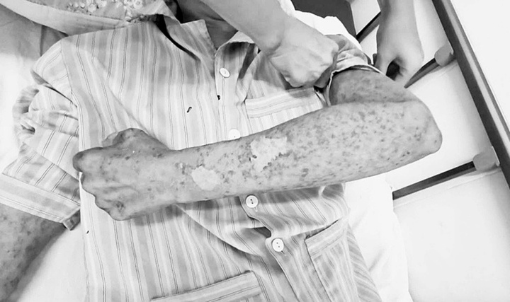 Nam công nhân bỏng nặng, mù tạm thời do tiếp xúc silicon chống dột