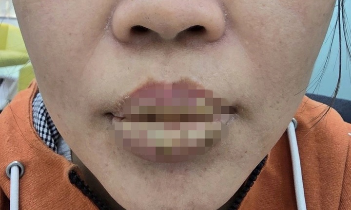Bi hài hậu vận thẩm mỹ: Xăm môi làm đẹp, người phụ nữ nhận trái đắng với biến chứng kinh hoàng