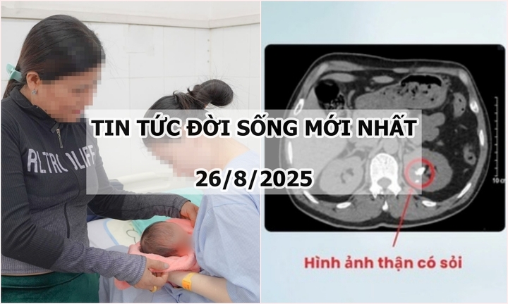 Tin tức đời sống 26/8: Tán sỏi qua da cho người đàn ông mắc dị tật thận đôi cực hiếm gặp