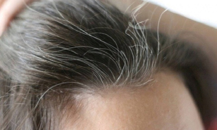 Vị trí thường có tóc bạc và nguyên nhân, cách khắc phục