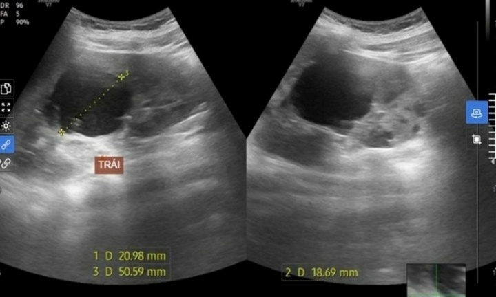 Khám sức khỏe, nam sinh 15 tuổi phát hiện mang căn bệnh 3 đời liên tiếp