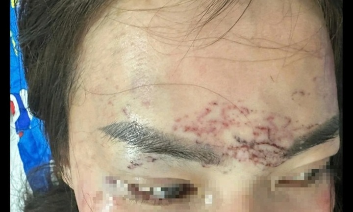 Thông tin mới nhất vụ đánh ghen, đổ axit, xăm mặt ở Cà Mau