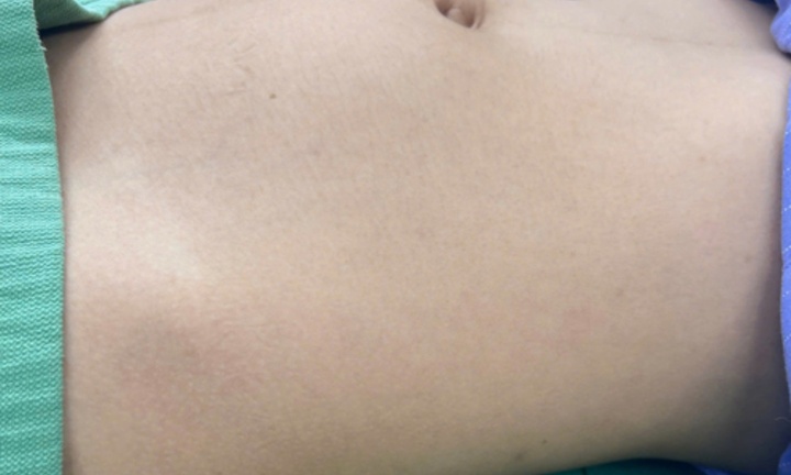 Bệnh nhi mới 15 tuổi được chẩn đoán ung thư tế bào mầm buồng trứng