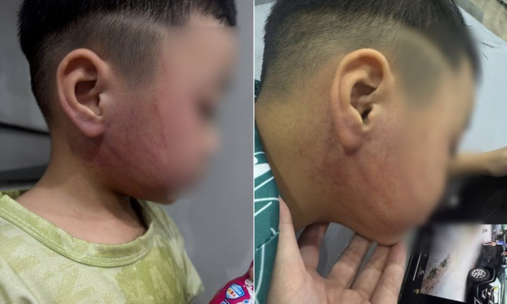 Vụ bé 4 tuổi nghi bị giáo viên mầm non ở Hà Nội đánh bầm tím mặt: Công an vào cuộc