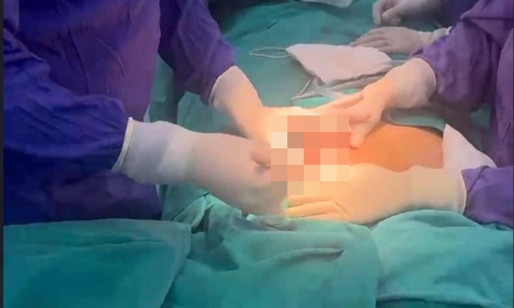 Người phụ nữ gặp biến chứng, hút ra hơn 2 lít dịch và silicon sau 5 năm nâng ngực