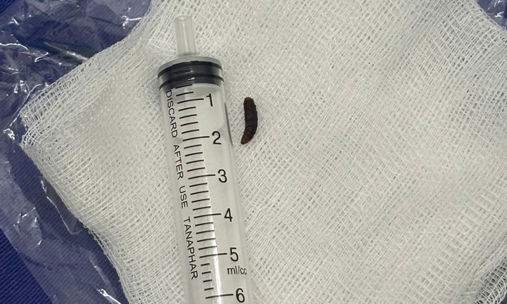 Kinh hãi phát hiện giòi ngo ngoe trong tai bé 14 tháng tuổi