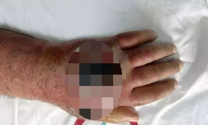 Chủ tiệm tạp hóa suýt phải cắt bỏ cánh tay vì bị kẻ cướp cắn