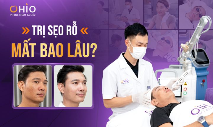 Trị sẹo rỗ mất bao lâu? Khám phá liệu trình hiện đại tại OHIO