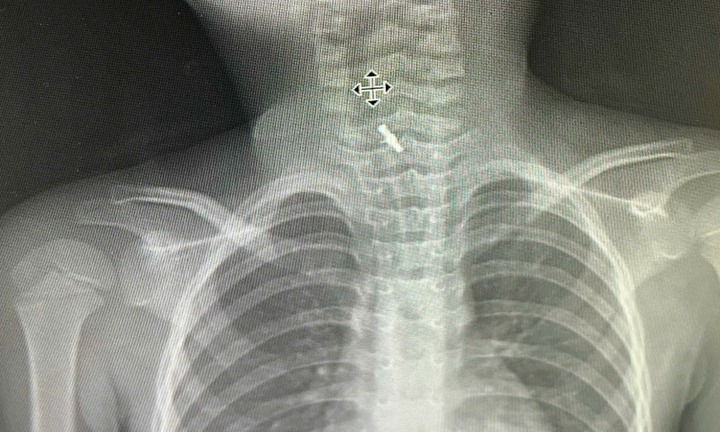 Nuốt kẹp tóc, bé gái 5 tuổi phải nhập viện cấp cứu