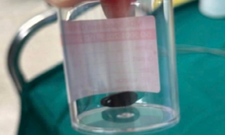 Bệnh nhi 13 tháng tuổi bị viêm phổi nặng, suy hô hấp do hóc hạt mãng cầu