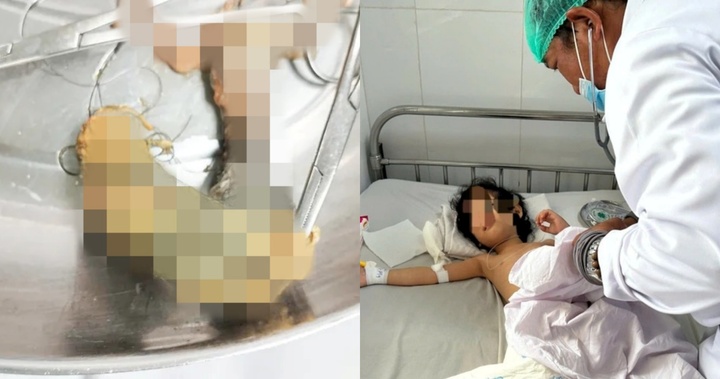 Bé gái 4 tuổi ở Cần Thơ mắc hội chứng 