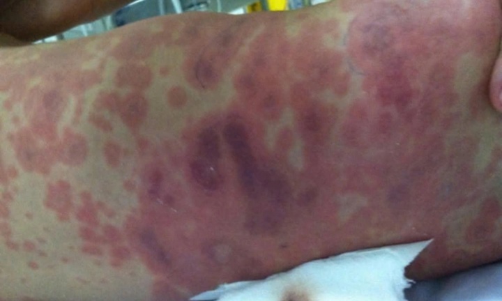 Bé gái 11 tuổi ở Hà Nội mắc viêm não mô cầu, bắt đầu bằng triệu chứng đau đầu, sốt cao