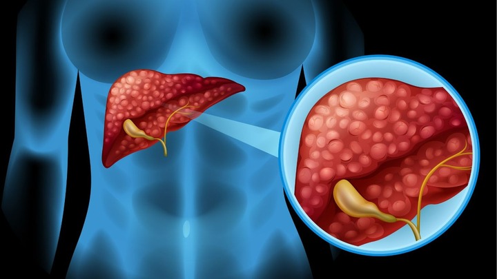 Những dấu hiệu cảnh báo viêm gan C