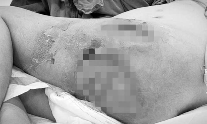 Cụ ông hoại tử vùng mông, đùi vì 1-2 nốt mụn nhọt