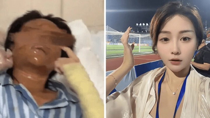 Nhặt gói hàng lạ đặt trước cửa nhà, nữ streamer xinh đẹp bị hủy dung trong tích tắc, khuôn mặt biến dạng vì bỏng nặng