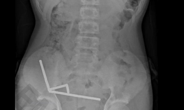 Cậu bé 13 tuổi nhập viện khẩn cấp vì nuốt gần 100 viên nam châm