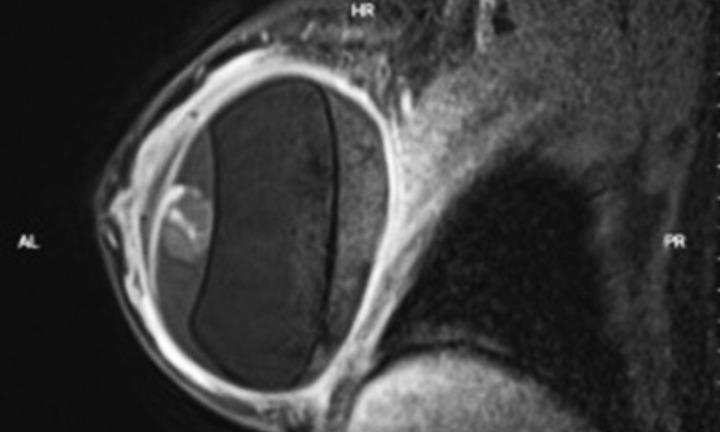 Tin tức đời sống 27/10: Người phụ nữ gặp biến chứng sau thời gian nâng ngực