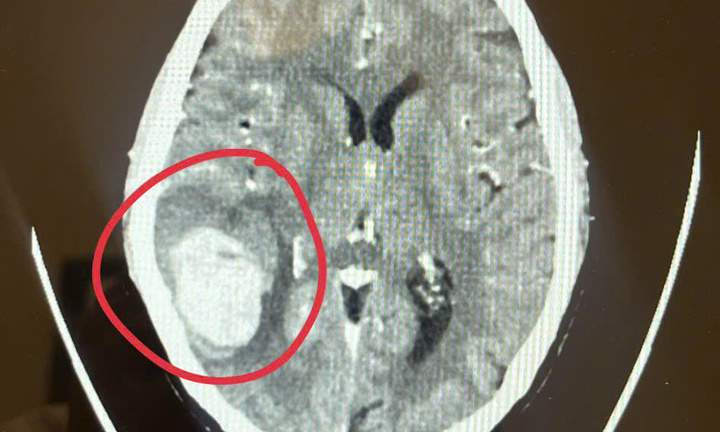 Người phụ nữ thoát đột quỵ nhờ sáng suốt “đi viện ngay khi thấy mặt méo”