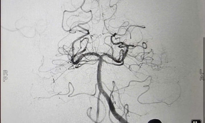 Uống vài cốc bia người đàn ông suýt tử vong vì thể đột quỵ có tỷ lệ chết tới 90%