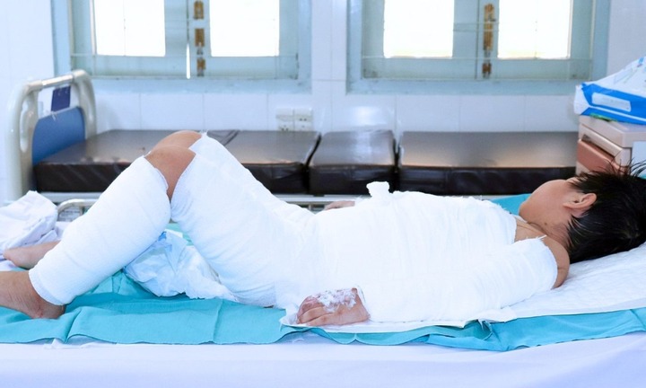 Nồi nước sôi của xe bánh bao văng trúng, bé trai 7 tuổi bỏng nặng