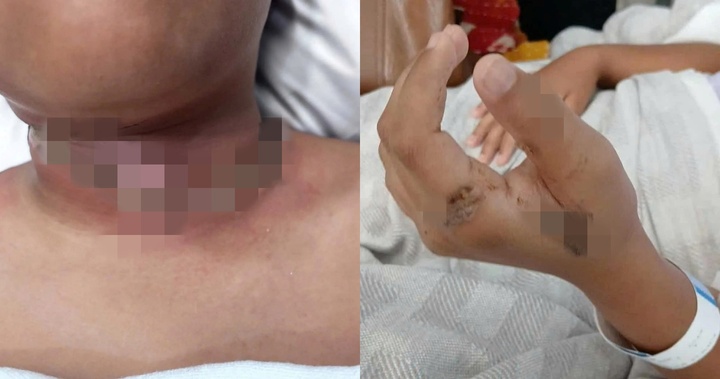 Bé trai 9 tuổi bỏng nặng do thói quen sạc máy tính bảng gần giường