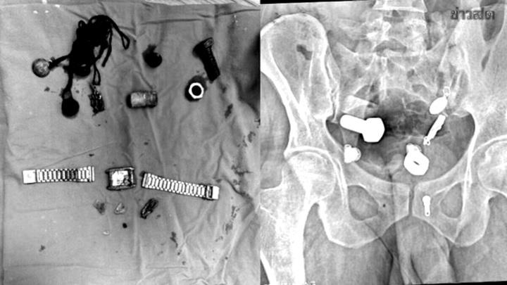 Đau bụng dữ đội không thể ăn uống, bác sĩ sốc nặng khi phát hiện nhiều 