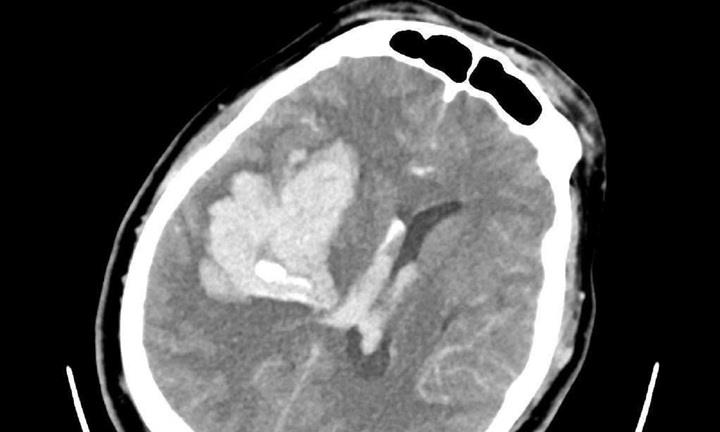 Chờ xe vào cấp cứu chồng gục trong nhà vệ sinh, vợ vắt chanh vào miệng