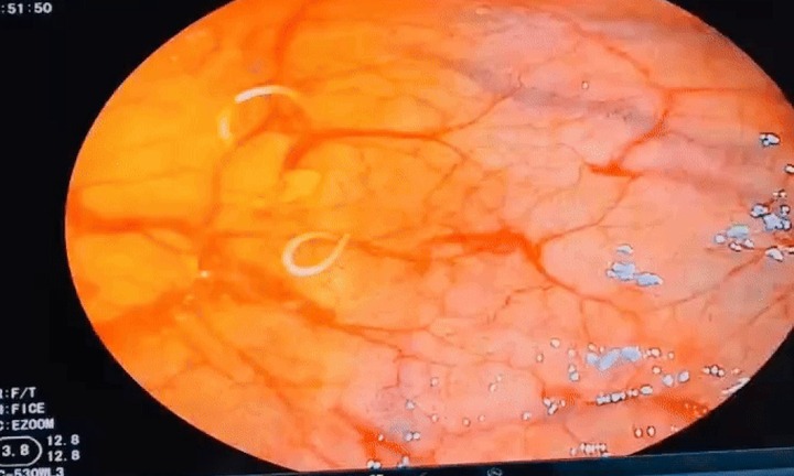 Tin tức đời sống 13/12: Người phụ nữ nhiễm giun nặng vì món ăn nhiều người mê