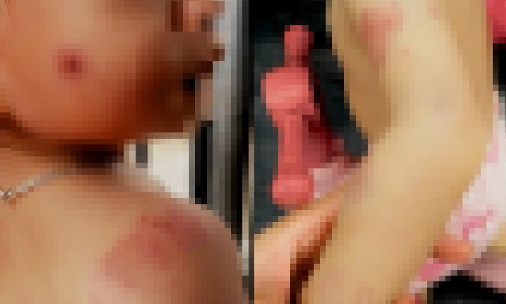 Bé gái 2 tuổi chi chít vết cắn, giáo viên trả lời