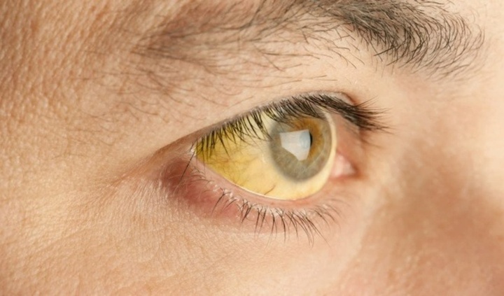 5 dấu hiệu chứng gan yếu biểu hiện ở mắt