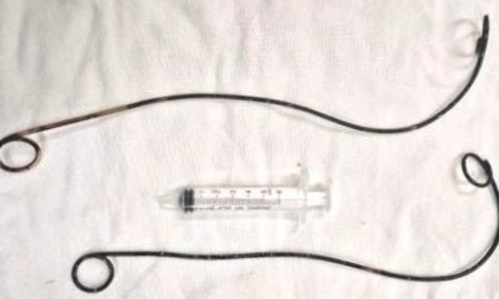 Tin tức đời sống 22/12: Lấy 2 ống thông bị 