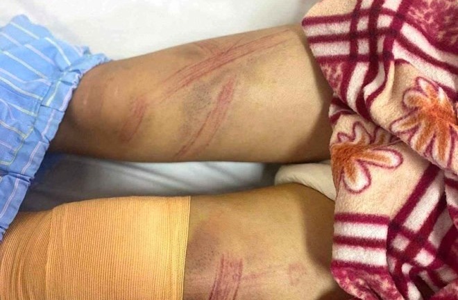 Vụ nữ sinh ở Nghệ An nhập viện với nhiều vết bầm tím: Lãnh đạo phường nói gì?