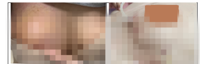 Tiêm filler vào ngực, cô gái 30 tuổi trả giá đắt từ lời quảng cáo 