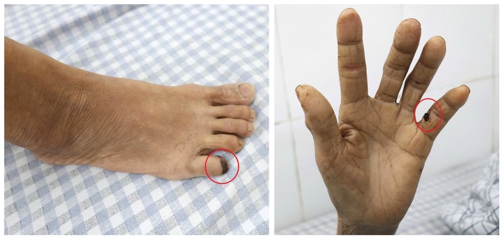 Bệnh nhân cứng hàm, co cứng toàn thân suýt mất mạng sau vết thương do gà đá