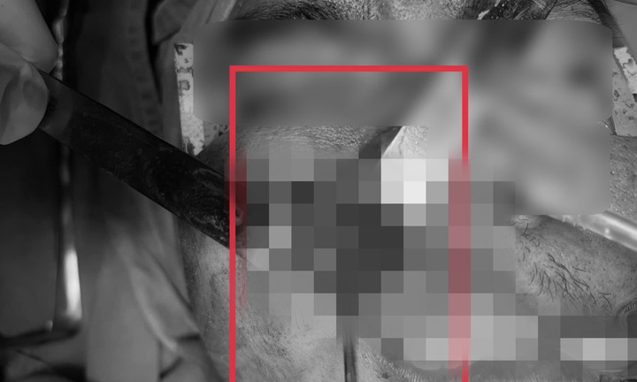 Đau xoang, cứng hàm tưởng uốn ván, bác sĩ phải phẫu thuật cấp cứu tối khẩn