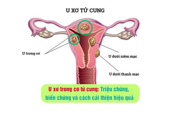 U xơ trong cơ tử cung: Triệu chứng, biến chứng và cách cải thiện hiệu quả