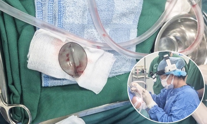 Chiếc muỗng nhựa mắc kẹt trong đường thở của bé trai 4 tuổi