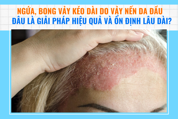 Ngứa, bong vảy kéo dài do vảy nến da đầu – Đâu là giải pháp cải thiện hiệu quả?