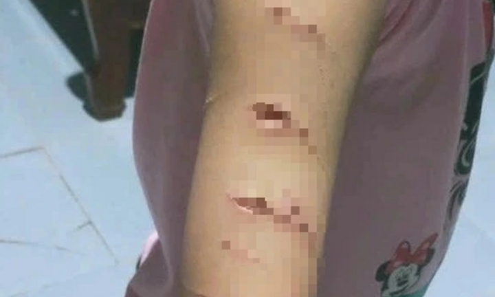 Nguyên nhân nữ sinh lớp 5 bị người thân dùng dao cắt giấy gây thương tích