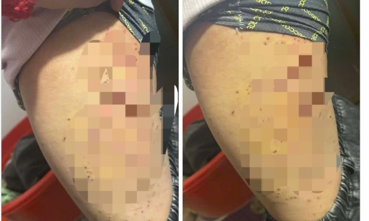 Vụ nữ sinh lớp 7 bị bạn dùng bút đâm vào đùi ở Lào Cai: Hé lộ nguyên nhân