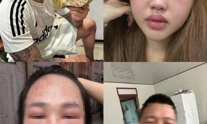 Bắt trend ăn bánh trứng kiến, nhiều người mặt sưng phù: Bác sĩ cảnh báo khẩn
